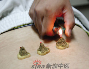 灸法的種類  你知道多少？