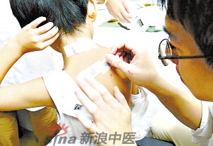 灸法的種類  你知道多少？